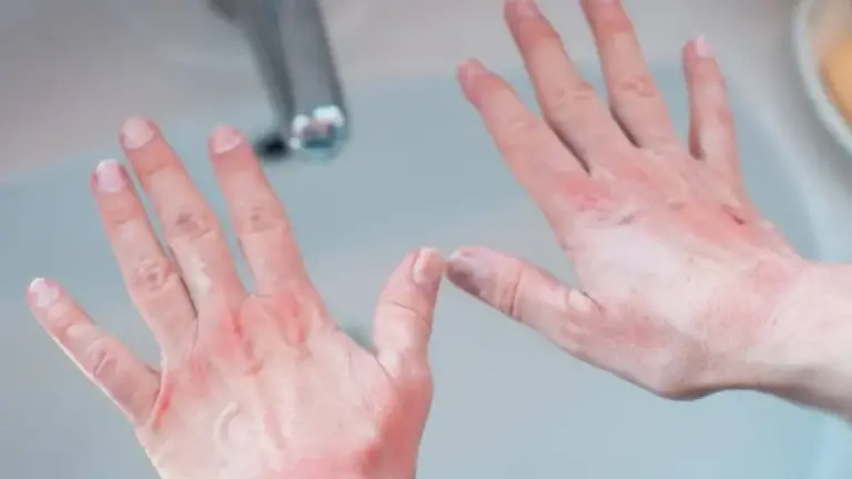 Ju skuqen duart? Kjo është një shenjë se diçka po ndodh me trupin tuaj.